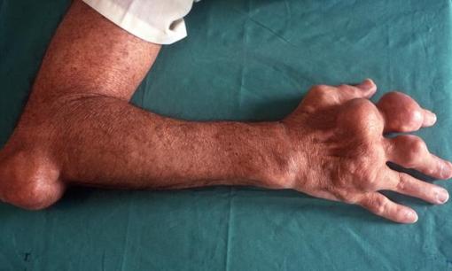 3 thói quen chính dẫn đến axit uric cao, chẳng trách bệnh gút sẽ “làm phiền” bạn, hãy nhanh chóng thay đổi nhé!