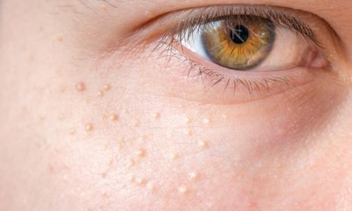 Những nốt mụn nhỏ màu trắng xuất hiện trên da là gì và cách xử lý chúng?