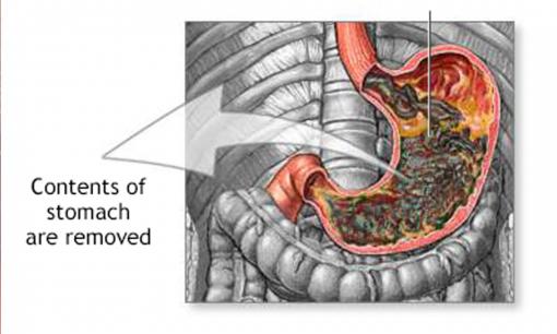 Nếu bạn có 5 triệu chứng này, hãy đi kiểm tra dạ dày ngay lập tức, đừng chần chừ, có thể sắp bị ung thư dạ dày