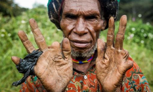 Kỳ lạ bộ tộc cắt một đốt ngón tay khi người thân qua đời, khi đốt tay không đủ thì cắt vành tai và mũi