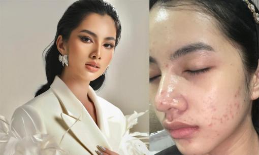 Sốc với gương mặt mộc đầy mụn của Cẩm Đan - 'tình tin đồn' chồng cũ Lệ Quyên