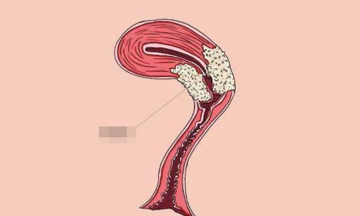 Phụ nữ khi đi vệ sinh hãy để ý nếu có 3 dấu hiệu này thì có lẽ tử cung đang 'cầu cứu'