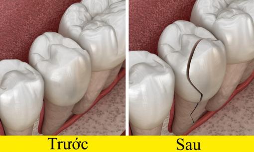 Đây là 4 lý do tại sao bạn không nên đánh răng sau khi ăn sáng