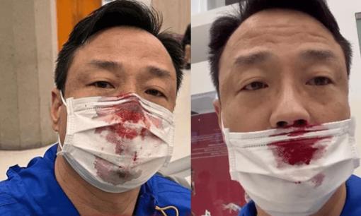 Sao Hong Kong 54 tuổi chảy máu mũi đầm đìa vì bị chọc dụng cụ quá mạnh khi đi test Covid-19