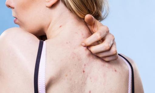 Dễ làm, khỏi bệnh dứt điểm. Mách bạn mẹo trị mụn ở lưng để không bị tái phát trở lại
