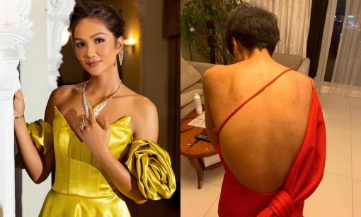 Hoa hậu H’Hen Niê gây xót xa với hình ảnh tấm lưng chi chít mụn trong mùa nóng