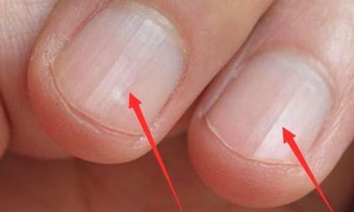 Trên móng tay có những 'đường kẻ dọc', phần lớn chỉ ra 4 vấn đề, có thể bạn phải chú ý hơn