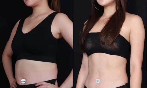 Bật mí phương pháp giảm béo thần tốc an toàn hiệu quả chỉ trong 60 phút