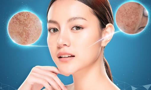 Có thể bạn chưa biết: Công nghệ Max Cell giúp xóa bỏ nám và tàn nhang vĩnh viễn