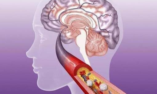 Một người đàn ông 33 tuổi đột ngột bị nhồi máu não. Chuyên gia: Hai thói quen này 'không thay đổi', những thói quen khác đều vô nghĩa!