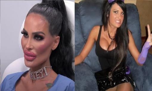 Người mẫu Australia - Tara Jayne bị biến dạng gương mặt, trở thành 'thảm họa thẩm mỹ' vì dao kéo