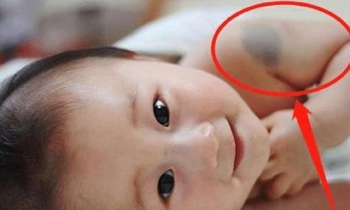 Ngoài di truyền, nguyên nhân khiến trẻ có vết bớt thì 3 hành vi này khi mang thai cũng là một trong những 'thủ phạm'