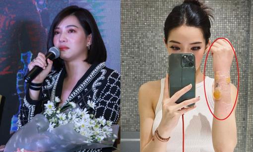 Lưu Đê Ly bị bỏng nặng, phồng rộp ở cánh tay vì pha nước tắm cho chồng, dân tình hối đi khám