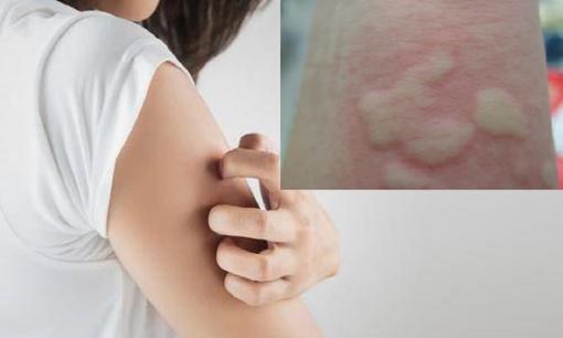 Làm thế nào để hết ngứa mề đay trong mùa hè? Phòng ngừa và điều trị nên được thực hiện trong ba bước, bạn đã hiểu chưa?
