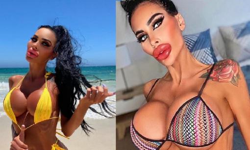 'Thảm họa thẩm mỹ' Úc khoe vòng một căng như quả bóng với loạt ảnh bikini