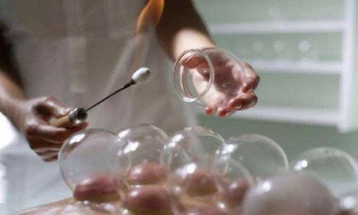 Trong khi giác hơi, máu ứ được hút ra ngoài có phải thải chất độc ra khỏi cơ thể không? Nghe những gì bác sĩ nói