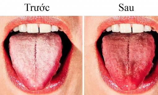 Tại sao lưỡi của bạn chuyển sang màu trắng và 8 cách để thoát khỏi vấn đề này?