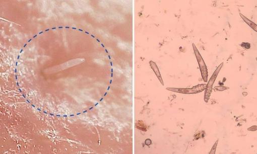 90% người lớn có nó! 'Loại bọ ve' này giao phối rầm rộ trên khuôn mặt: rửa mặt cũng vô ích