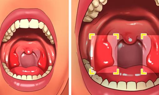Sỏi amidan là gì và nguyên nhân gây ra chúng