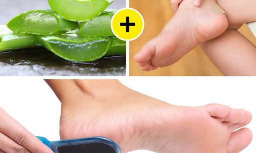 9 cách nhanh chóng giúp loại bỏ vết chai để có được đôi chân mềm mại như da em bé