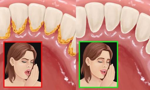 Giảm ngay mùi hôi miệng nhanh chóng với những cách đơn giản không ngờ