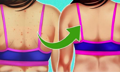 6 cách trị mụn lưng hiệu quả giúp nàng tự tin diện áo hai dây, khoe lưng trần gợi cảm
