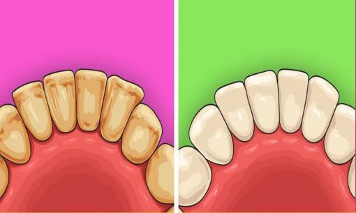 5 cách để loại bỏ mảng bám trên răng, tránh sâu răng ảnh hưởng đến sức khỏe