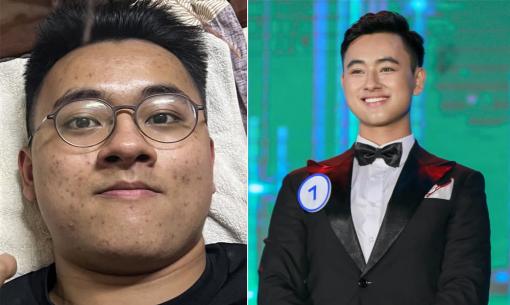 Hành trình 'lột xác' của chàng trai vừa béo, mặt đầy mụn vươn tới vị trí 'Nam vương vạn người mê' ở trường Đại học