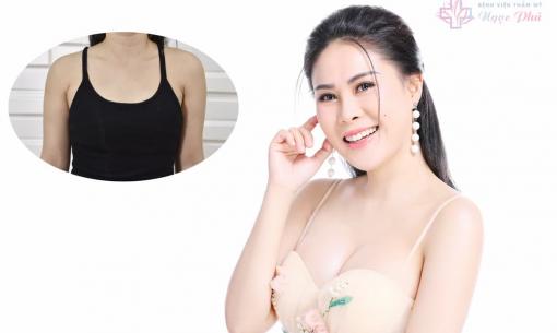 Khách hàng chia sẻ hành trình nâng ngực nội soi tại Bệnh viện Thẩm mỹ Ngọc Phú