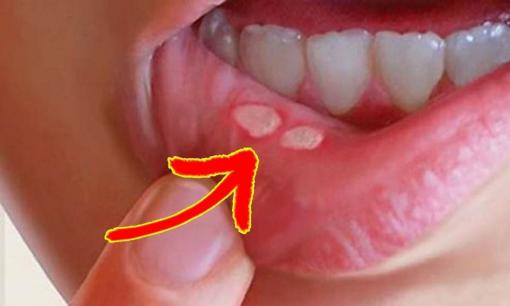 Nguyên nhân gì dẫn đến nhiệt miệng và 15 cách để giúp vết nhiệt miệng nhanh lành