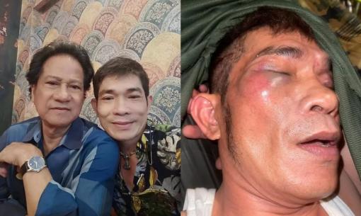 Con trai của danh ca Chế Linh bất ngờ bị đánh hội đồng, hàng loạt vết thương gây lo lắng 