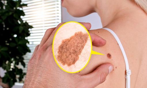 Tại sao nốt ruồi xuất hiện và khi nào cần đến bác sĩ để kiểm tra?