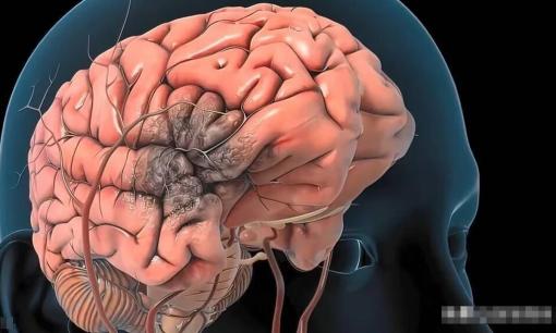 Trước khi xuất hiện xuất huyết não, cơ thể thường có 5 “tín hiệu” lớn này, đừng chậm trễ sau khi phát hiện 