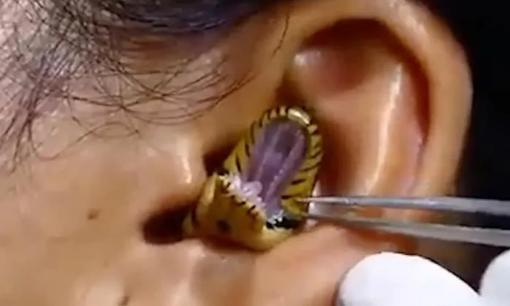 Rùng mình với đoạn clip gắp rắn kẹt trong tai người phụ nữ
