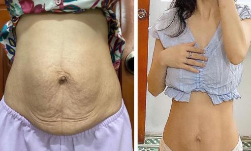 5 cách giúp bụng sau sinh xẹp nhanh hơn, xóa tan nỗi lo bụng chảy xệ, không săn chắc