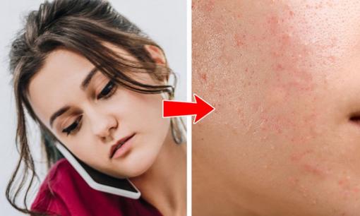 Mụn trứng cá trên 8 bộ phận này của cơ thể cho bạn biết về sai lầm trong thói quen sinh hoạt hàng ngày