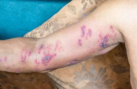 Bệnh giời leo gây đau đớn tột cùng, 6 nhóm người này rất dễ trở thành mục tiêu của nó, cần thực hiện các biện pháp phòng tránh 