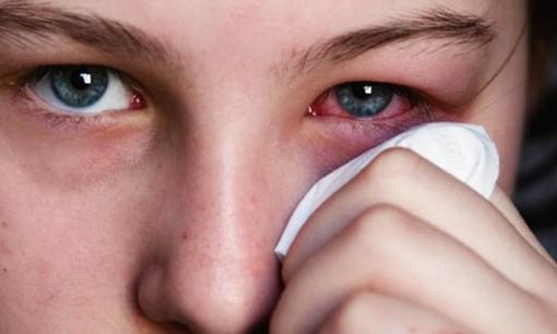 4 kỹ thuật để giảm sưng húp mắt, làm thế nào để thực hiện tại nhà?