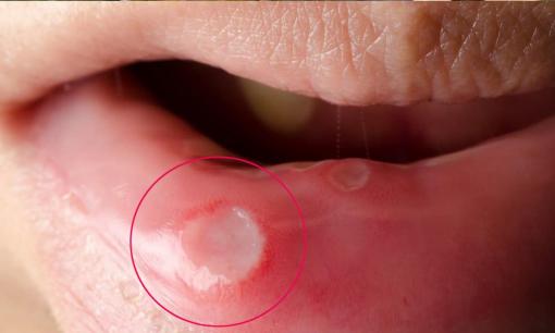 Chính xác thời kỳ cao điểm của bệnh loét tái phát vào mùa thu? Hãy ghi nhớ những mẹo này