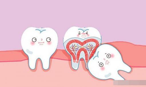 Tại sao không thể nhổ hết răng khôn cùng một lúc? Bệnh nhân có 4 chiếc răng khôn bị ảnh hưởng