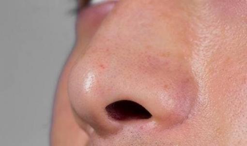 Lông mũi mọc ngoài lỗ mũi có nhổ hay tỉa được không? Lông mũi dài quá, có chuyện gì vậy?