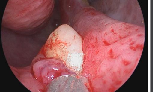 Hi hữu: Một người đàn ông có răng mọc trong mũi