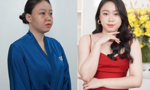 Tạm biệt hốc hác, gương mặt đầy đặn với công nghệ Mô sinh học Bio MaxFace