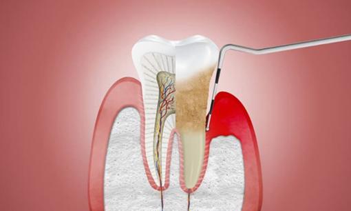 Điều trị viêm nha chu hiệu quả và nhẹ nhàng hơn với laser LightWalker