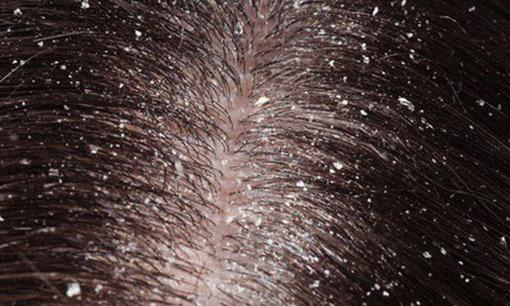 5 cách trị gàu đơn giản bằng nguyên liệu tự nhiên, kết hợp với dưỡng tóc mượt mà trong mùa thu đông