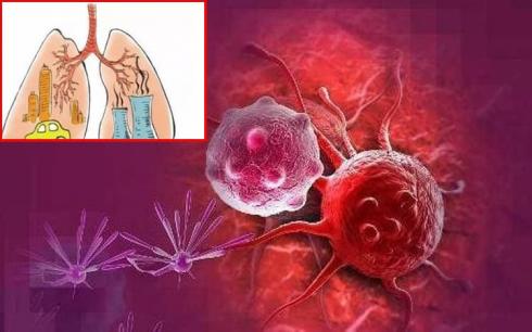 Dấu hiệu ban đầu của 'ung thư phổi' không phải là ho khan, hai triệu chứng này bị nhiều người 'bỏ qua'