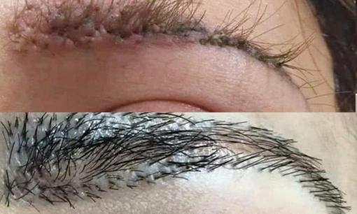Nghe lời 'ngon ngọt' của cơ sở làm đẹp, người phụ nữ chi tiền cấy lông mày và cái kết nhìn thôi cũng 'khóc thét' 