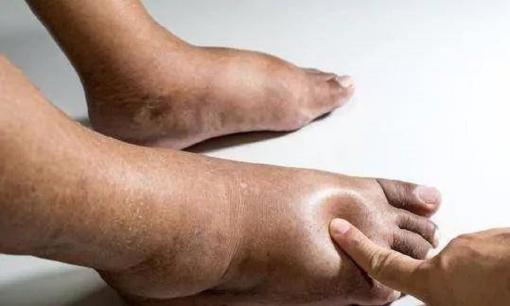 Nghẽn mạch máu, bàn chân tiên tri, bất kể nam hay nữ, 4 triệu chứng này xuất hiện ở bàn chân hãy kiểm tra càng sớm càng tốt