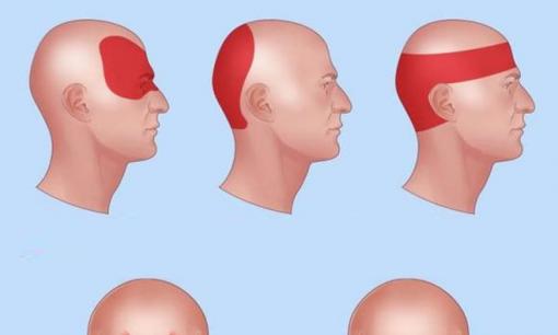 Làm thế nào để giúp ngăn chặn cơn đau đầu