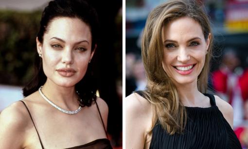 10 người nổi tiếng thay đổi hoàn toàn nhờ 'phép thuật' của phẫu thuật thẩm mỹ 